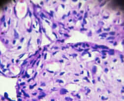 Ovary cystadenoma biopsy under light microscopy zoom in different area