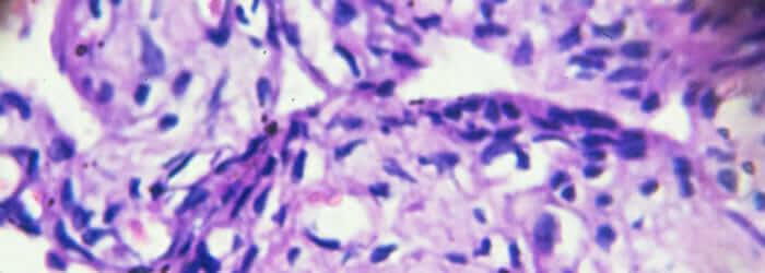 Ovary cystadenoma biopsy under light microscopy zoom in different area